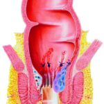 technique-hal-doppler-traitement-hemorroides-gd