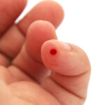Bleeding finger