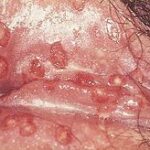 SOA-Herpes-genitalis-female