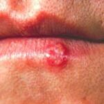 herpes-labial