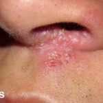 nose-herpes