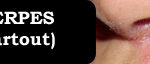 onglet-herpes